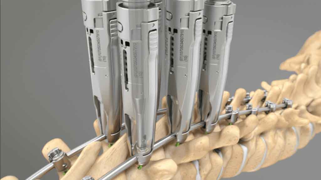 Depuy Viper 3D device in use for minimally invasive spine treatment. Device attached to T7-L4 vertebrae for precise and effective treatment of severe curvature in the spine. Advanced technology improves outcomes and speeds up recovery time.
