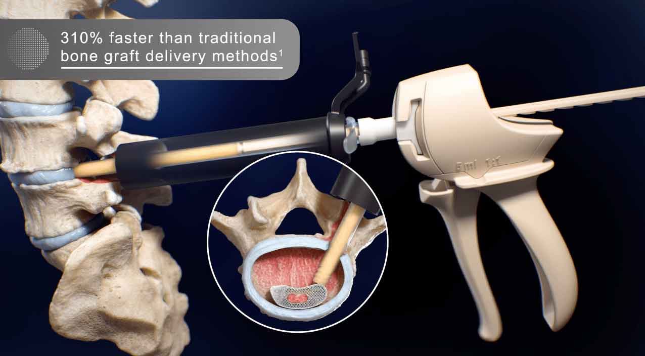 DePuy Synthes, ViviGen, Bone Graft, bone regeneration, natural healing process, new bone tissue, damaged bones, advanced technology, superior performance, optimal bone regeneration, medical specialties: orthopedics, sports medicine, trauma surgery, podiatry, plastic surgery, maxillofacial surgery, spinal surgery, neurosurgery.