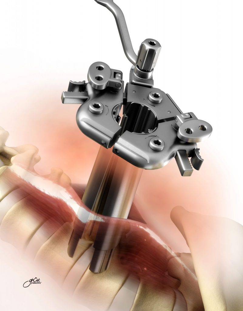 Revolutionary DePuy Spine Device provides support & stability to spine for spinal treatment. Innovative design & advanced technology make it a safe & effective solution for spinal conditions & injuries. Discover the power of DePuy Spine Device for a healthier, happier, & more active life.