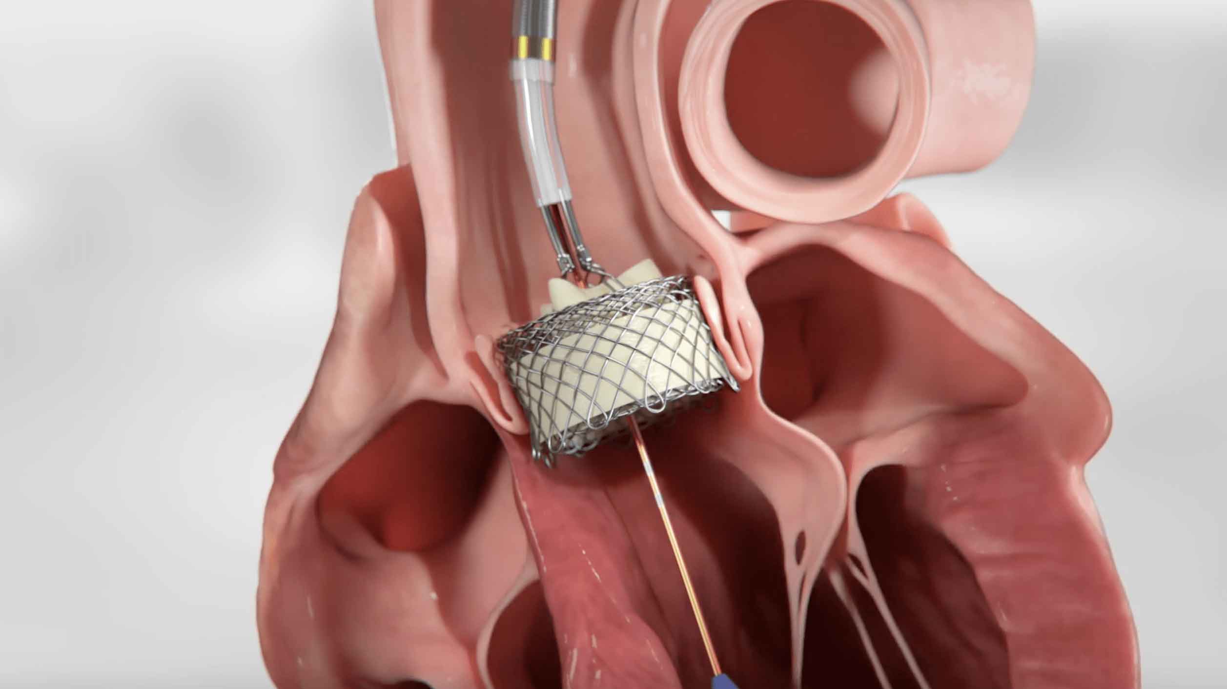 HLT TAVR, heart, cardiovascular system, blood vessels, chambers, medical professionals, medical students, cardiology, interventional cardiology, cardiovascular surgery, cardiac imaging, anatomy, heart procedure, heart surgery, heart valve, heart valve replacement, minimally invasive surgery, medical education, medical training.
