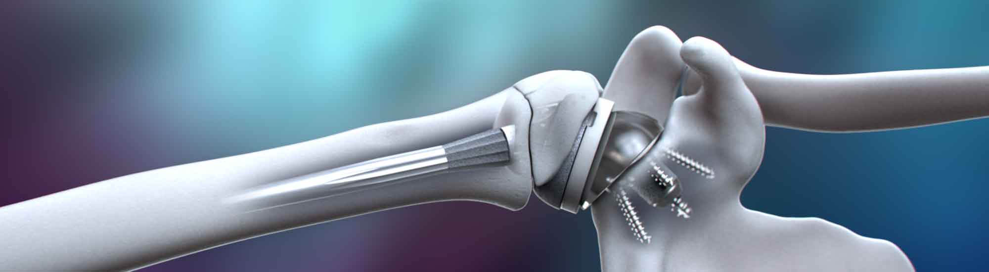 3D animation of Integra Life Sciences Shoulder Plates by Ghost Productions. Shows Modular Shoulder, Reverse Shoulder, and Proximal Humeral Plating Systems. Highlights innovative features and benefits. Improves patient outcomes.