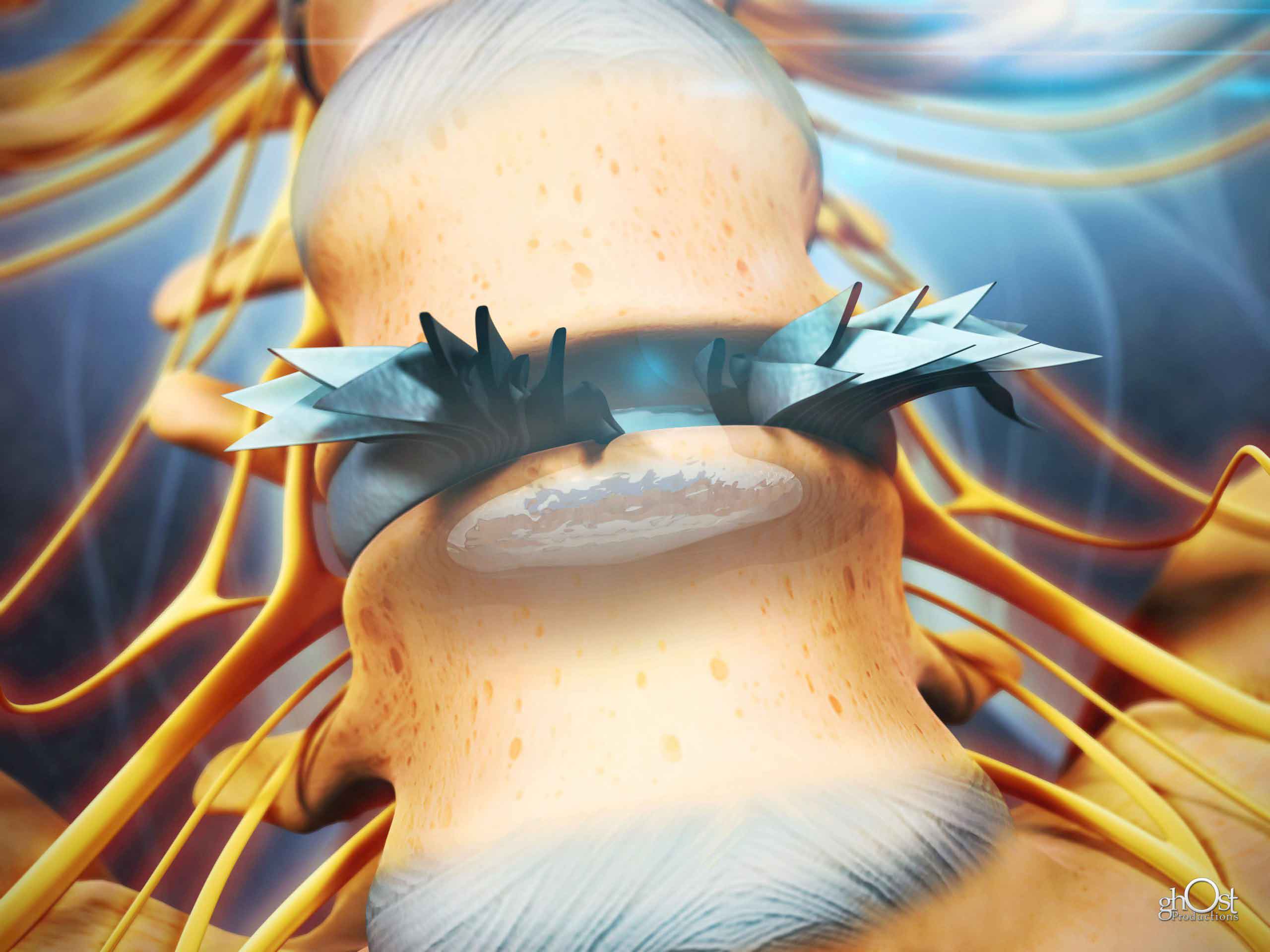 Medical illustration of a herniated disk in the spinal column, showing the location of the disk and surrounding nerves. Useful for diagnosing and treating back pain.