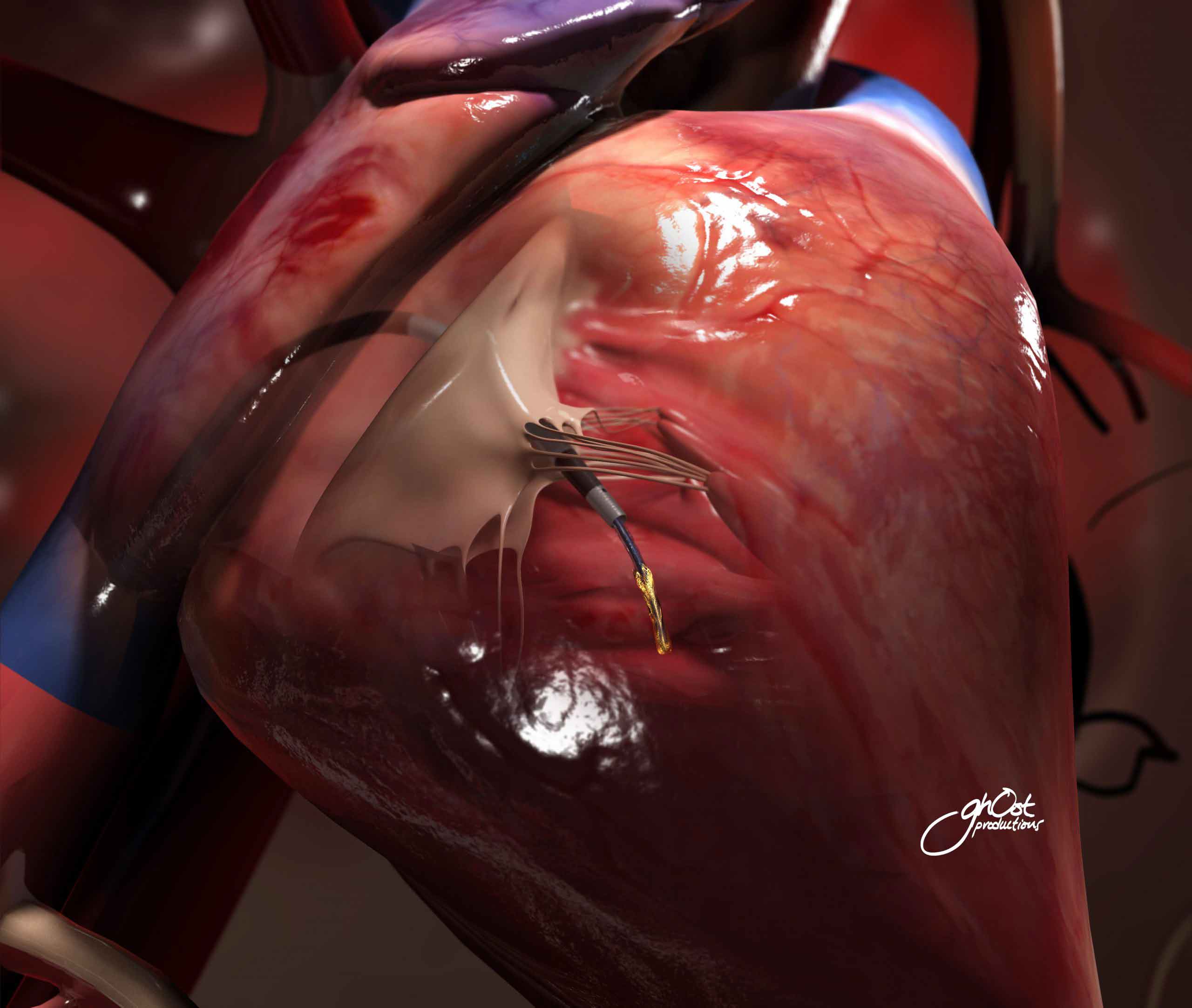 A medical illustration of the MC10 Concept Animation for Wearable Technologies. The image depicts a person wearing a telemetry implant that monitors and provides diagnostic data through RFID technology. This innovative concept has the potential to revolutionize healthcare and wellness. Created by Worrell Ghost Productions for a TED talk on the future of wearable technology.