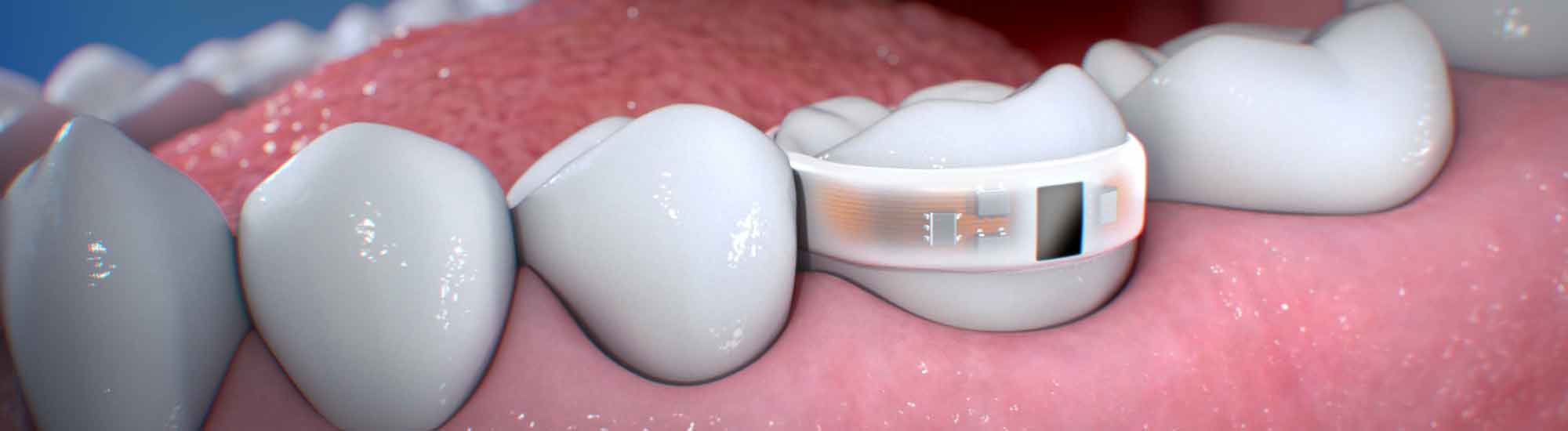 Lura Health, U-CHU Device, salivary diagnostic sensor, dental health, dental PH sensor, acid levels, real-time data, U-CHU APP, personalized product recommendations, tooth decay prevention, wearable technology, oral health, brighter smile, medical specialties: dentistry, oral medicine, periodontics, endodontics, prosthodontics, orthodontics, pediatric dentistry.