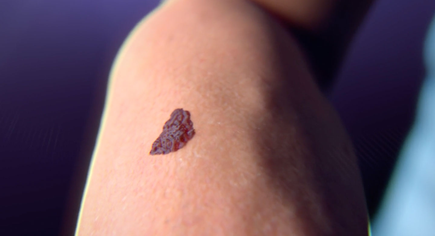 skin cancer treatment, NanoNeedle Biodegradable Microneedle Patch, antigenic peptide delivery system, systemic immune response, cancer treatment, medical animation, VR surgery, Ghost Productions, medical specialties, dermatology, oncology, immunology, pathology, surgery, medical research.