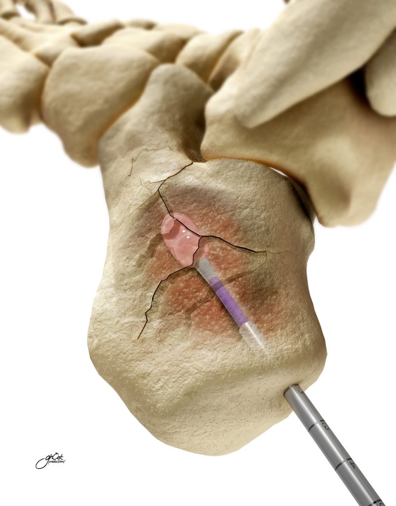 Medtronic's KyphonReel Fracture Management System is showcased in a visually engaging animated character illustration by Ghost Productions. The cutting-edge technology helps healthcare professionals manage fractures effectively. The animation highlights the system's capabilities. Expert animation skills make the system visually captivating for medical professionals and patients.