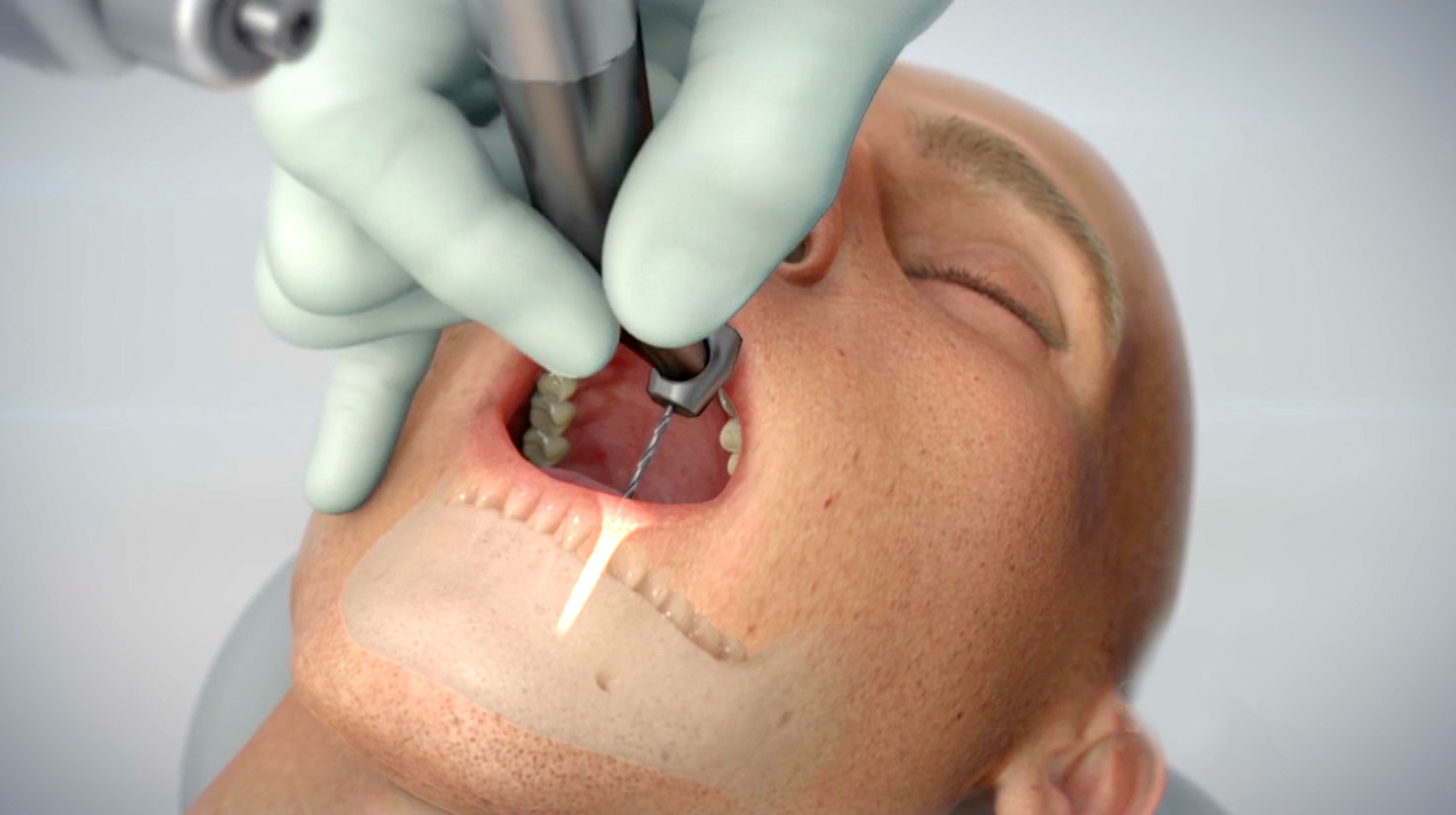 dental implant surgery, Neocis YOMI Robotic Guidance System, groundbreaking technology, precision, accuracy, dynamic planning software, real-time adjustments, collaborative robotic arm, visual feedback, optimal results, dental implants, robotic guidance, dental surgery, dental technology, dental precision, dental accuracy, dental robotics, dental innovation, dental implant specialists, dental surgeons, oral surgeons, periodontists, prosthodontists.