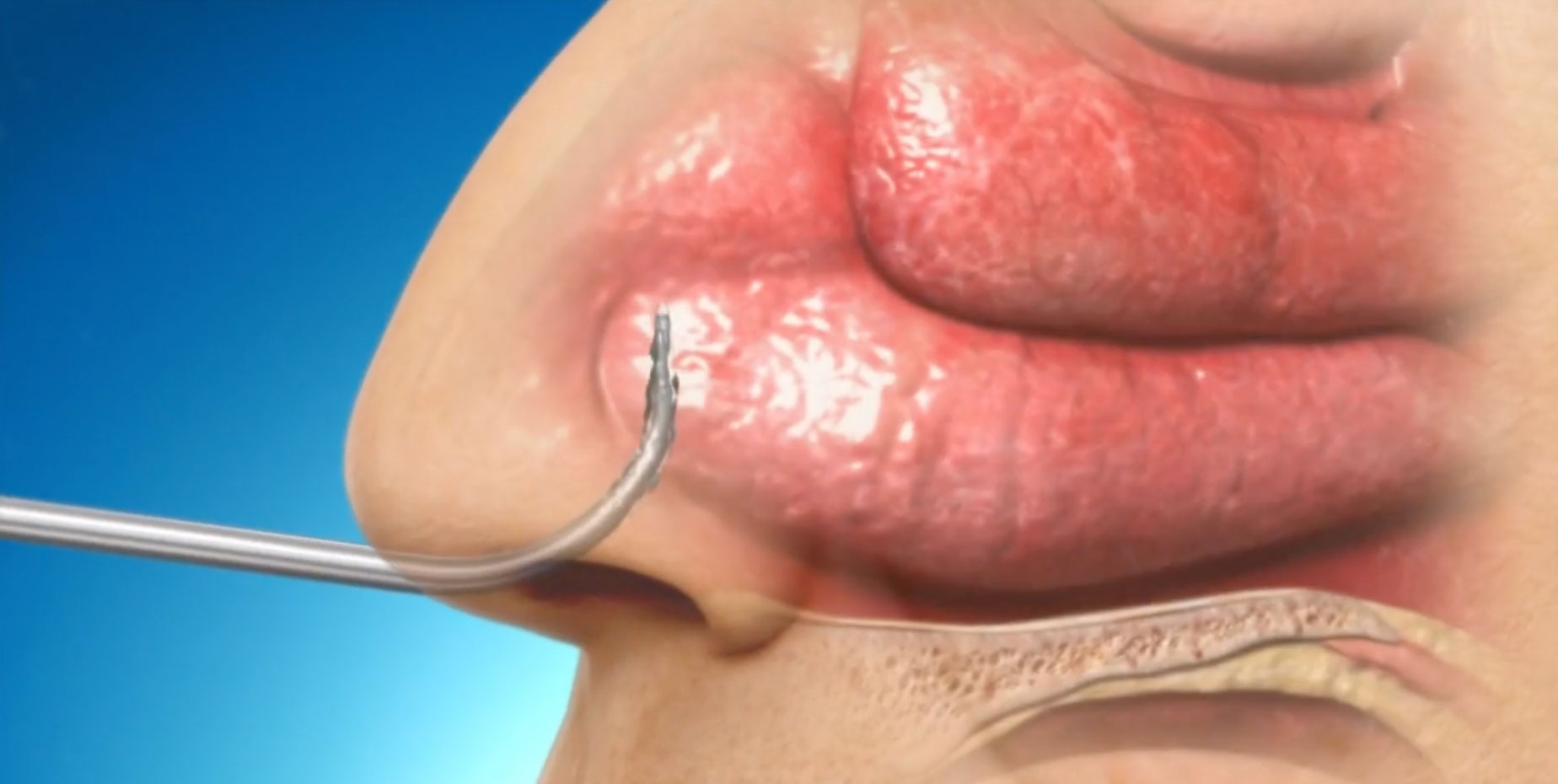 NuVent Sinus Dilation System, Medtronic, sinus relief, inflatable balloon tip, chronic sinusitis, sinus cavities, sinus-related discomfort, effective solution, medical specialties: otolaryngology, allergy and immunology, pulmonology, internal medicine, family medicine, pediatrics, neurology.