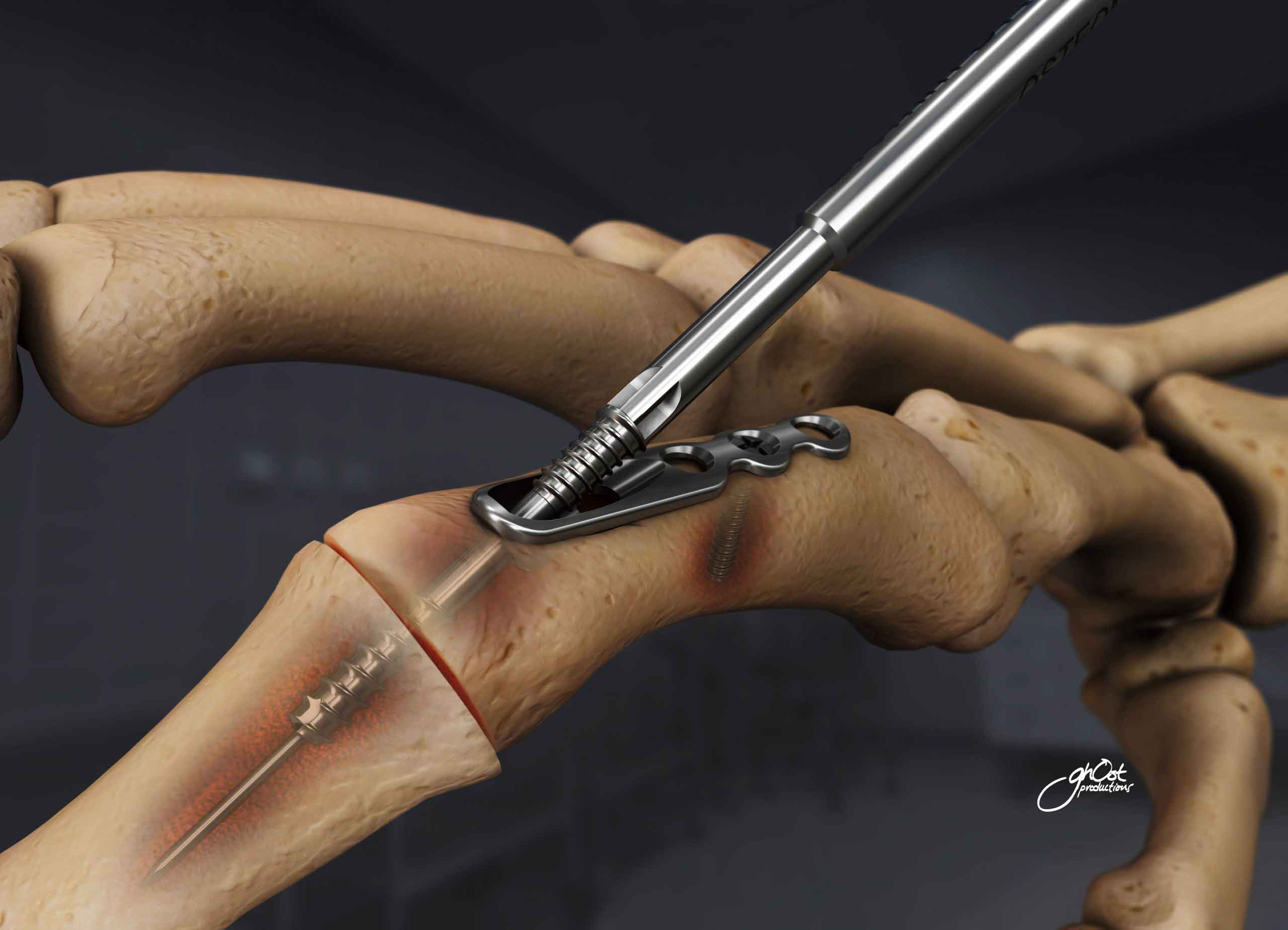 The Osteomed Fusion Joint Fixation System is an orthopedic solution for joint stability in patients with injuries or conditions requiring surgery. Made of high-quality materials and advanced technology, it promotes faster healing and improved joint function.