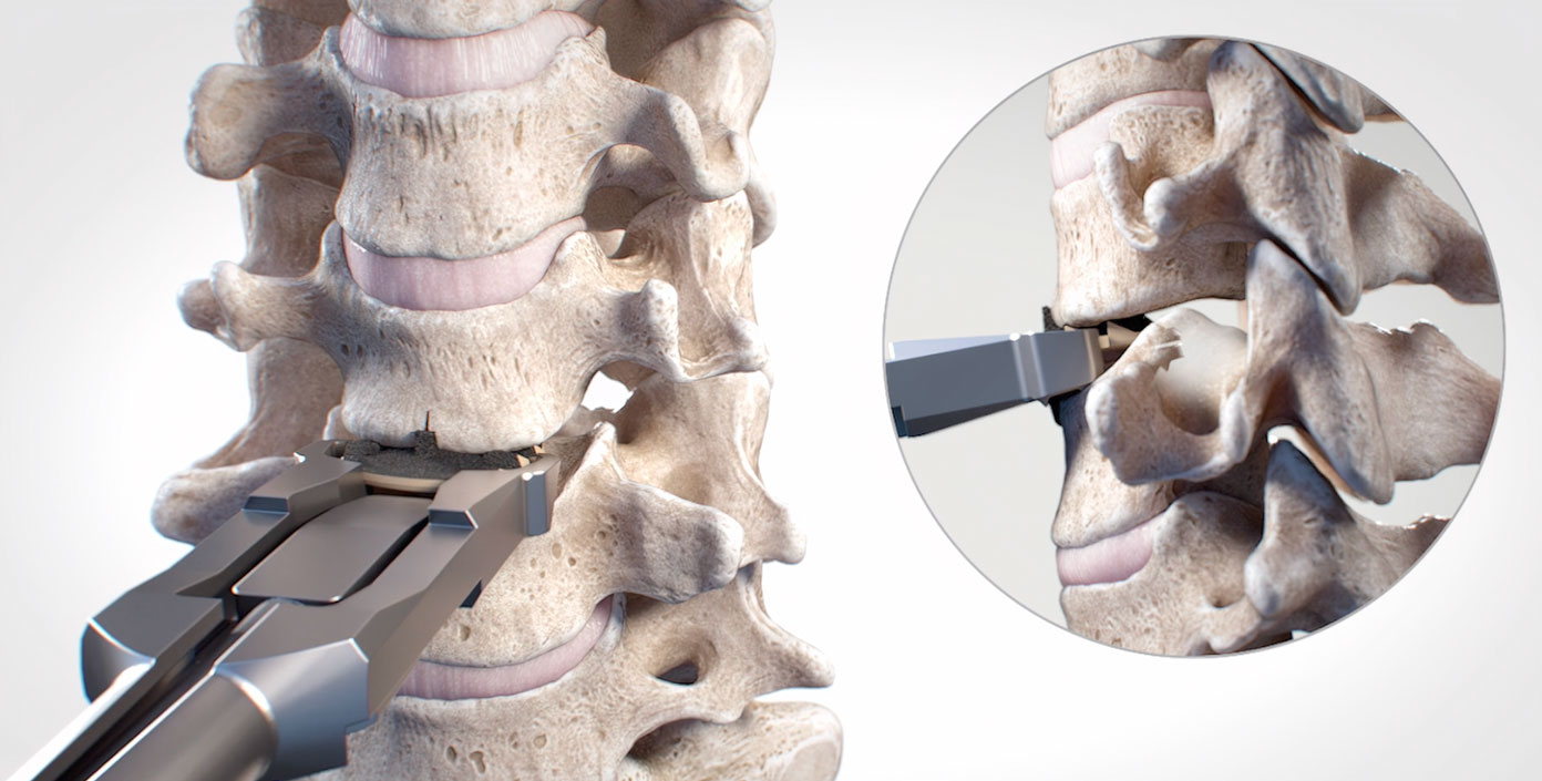 NuVasive Simplify Disc ADR Surgical Technique medical illustration. Minimally invasive approach to spinal surgery for degenerative disc disease. Advanced technology and precision for faster recovery times and improved outcomes. Trust in NuVasive for expert care.