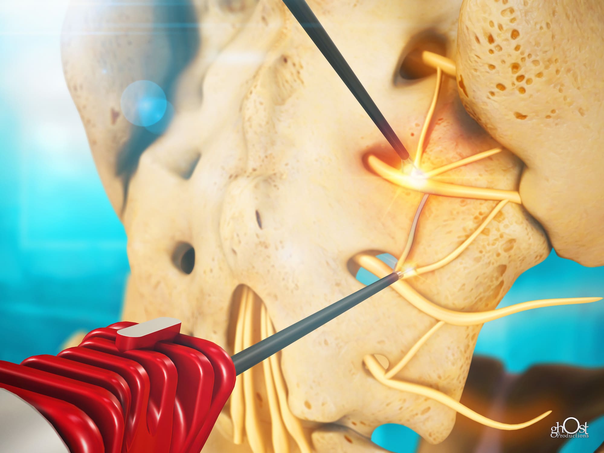 NimbusRF Electrode, medical device, radiofrequency thermal neurotomy procedures, pain management, Nimbus Concepts, Ghost Productions, animation, advanced technology, medical professional, care, comfort, pain relief, ultimate solution, revolutionary device, medical specialties, anesthesiology, pain medicine, neurology, physical medicine and rehabilitation, orthopedics, radiology, interventional radiology, pain management clinics.