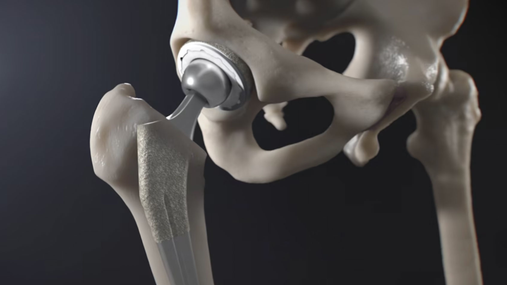 Revolutionary New Era Orthopaedics Hip Replacement for joint pain. Innovative design & state-of-the-art materials provide comfort & mobility. Get back to daily activities with ease. Groundbreaking hip replacement for a new era of orthopaedic care.