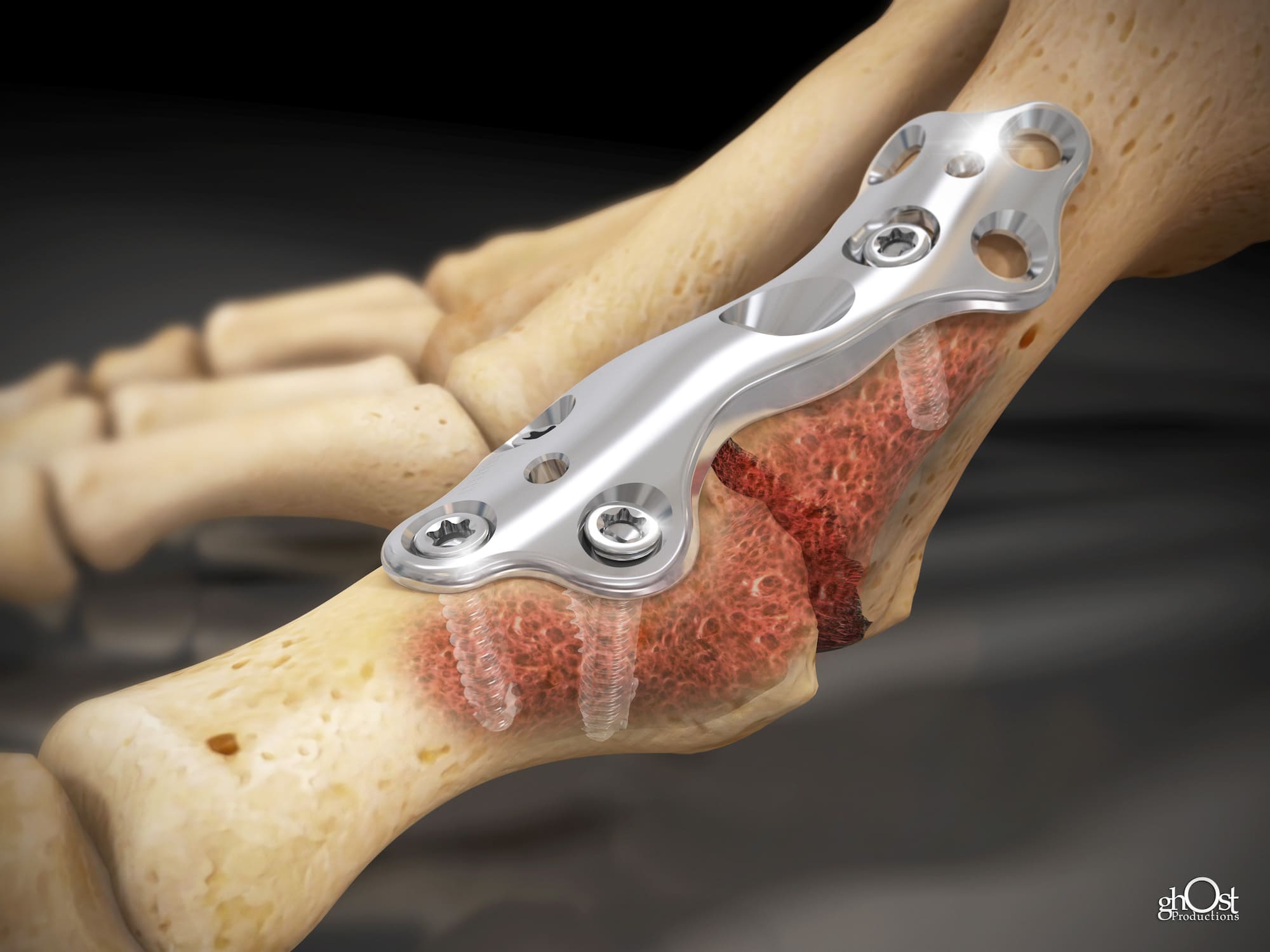 Revolutionary OsteoMed Footplate Device for Foot Fractures and Pathologies. Animated video by Ghost Productions. Features small plate solutions for foot fractures and pathologies. Non-locking, angled locking, and cannulated lag screws for precision and stability during surgery. Invaluable tool for medical professionals.