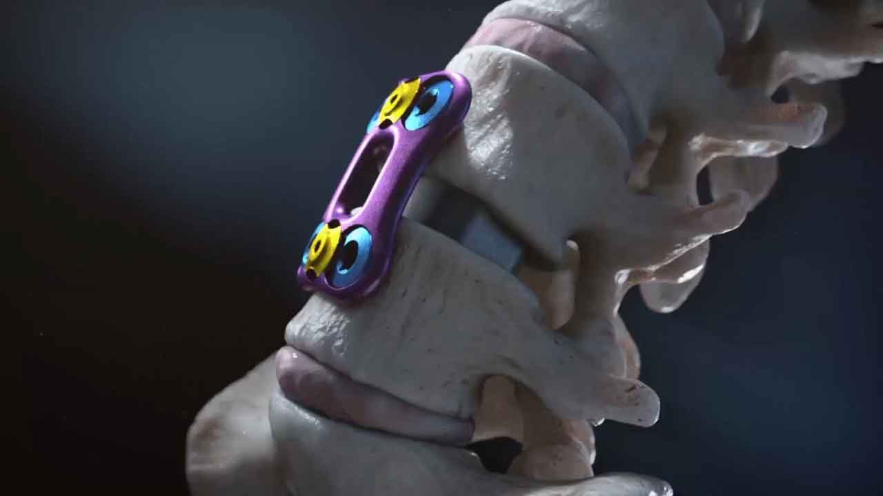 spinal implant, medical device, mobility, pain relief, spinal conditions, support, stability, spine, active lifestyle, spinal health, enhanced mobility, pain management, Aesculap, orthopedics, neurosurgery, physical therapy, rehabilitation, pain medicine, sports medicine, chiropractic, osteopathy, physiatry, radiology, anesthesiology, orthopedic surgery, neurology, interventional pain management, pain management clinic.