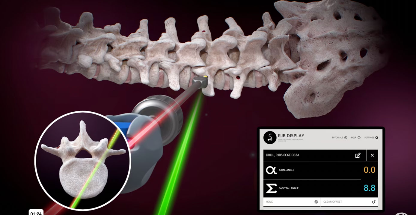 A medical illustration showing the Ruthless Spine RJB Surgical Navigation technology. The technology provides an objective measurement of screw trajectory for precise screw placement during surgery. This improves surgical outcomes and reliability. Trust in the precision of Ruthless Spine RJB surgical navigation for your next procedure.