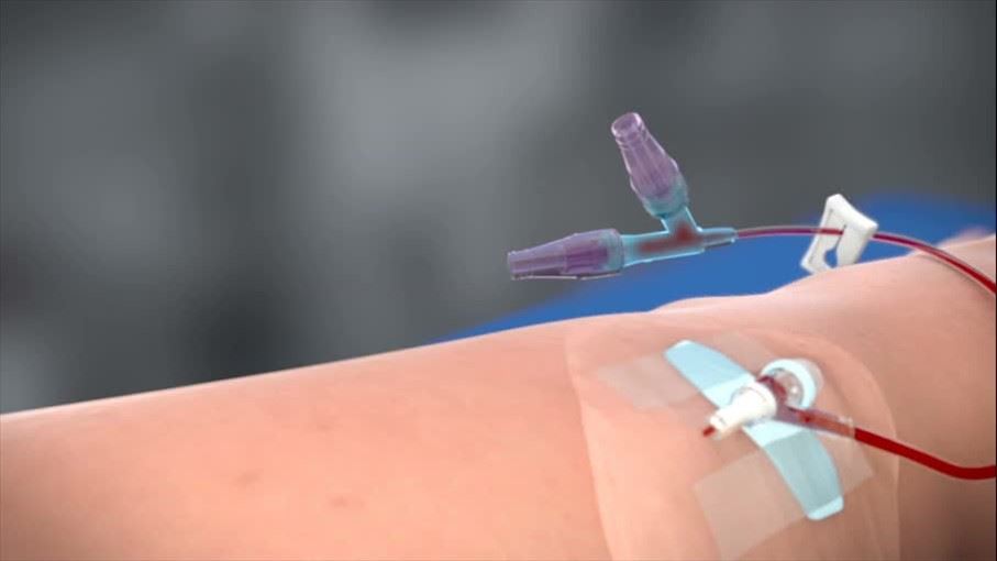 Smiths Medical, DeltaVen, infusion therapy, hemodialysis treatment, medical technology, medical devices, kidney failure, healthcare professionals, reliable infusion therapy, advanced features, exceptional performance, medical facility, high quality care, precision, global expertise, quality healthcare. Medical specialties: Nephrology, Dialysis, Renal Medicine, Urology.