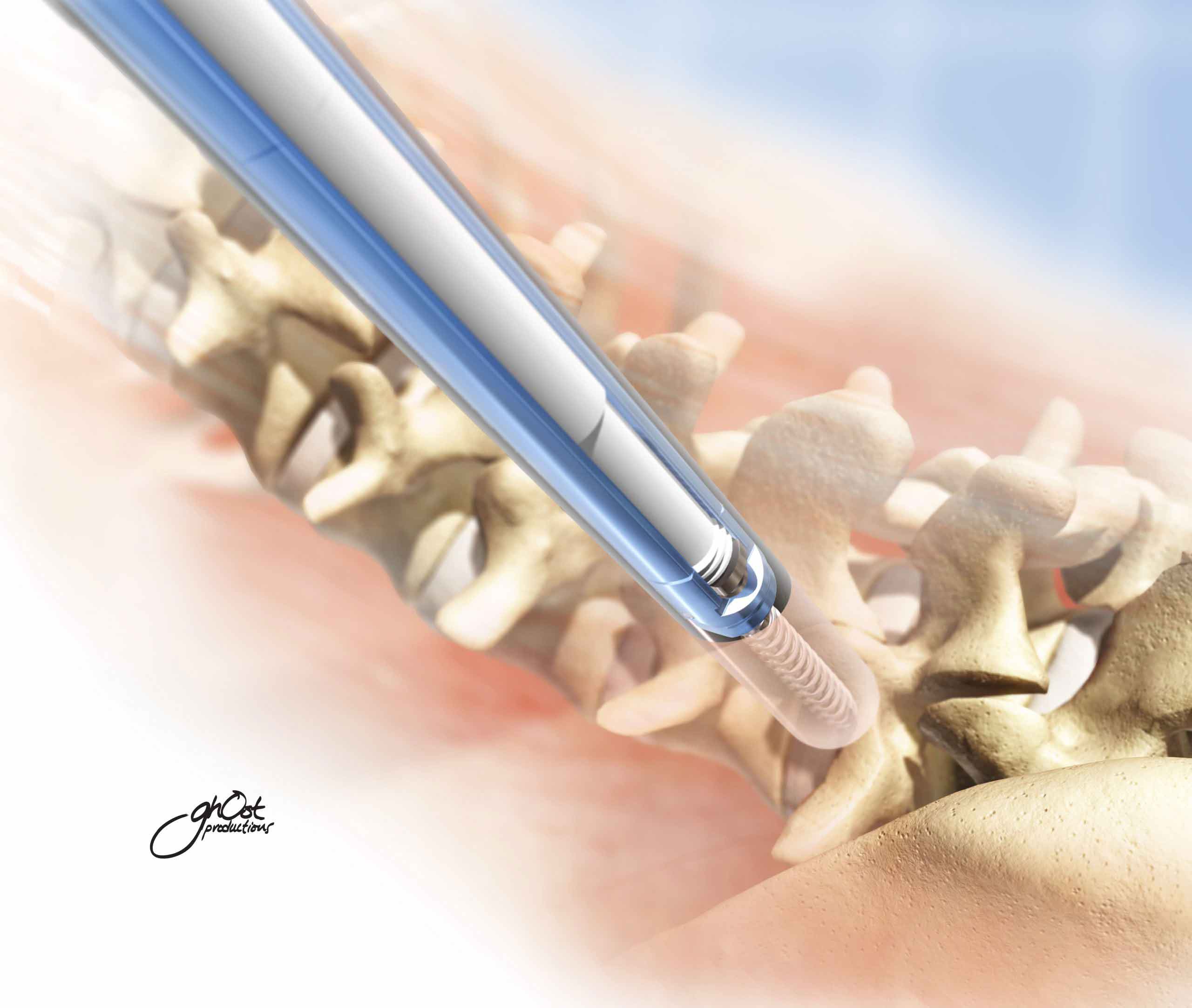 SeaSpine NewPort is a revolutionary MIS posterior fixation system with low profile screws. It uses extended-tab screws for smaller incisions and minimal tissue disruption. This system offers precision and control, making it ideal for minimally invasive spine surgeries. Experience the future of spinal fixation with SeaSpine NewPort.