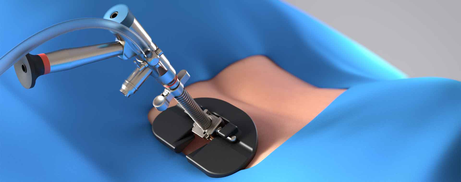 Spineology, spinal device, spinal health, spine support, spine stability, pain relief, mobility improvement, innovative design, advanced technology, medical device, orthopedics, neurosurgery, physical therapy, chiropractic, pain management, sports medicine, rehabilitation, orthopedic surgery, spine surgery, neurology.