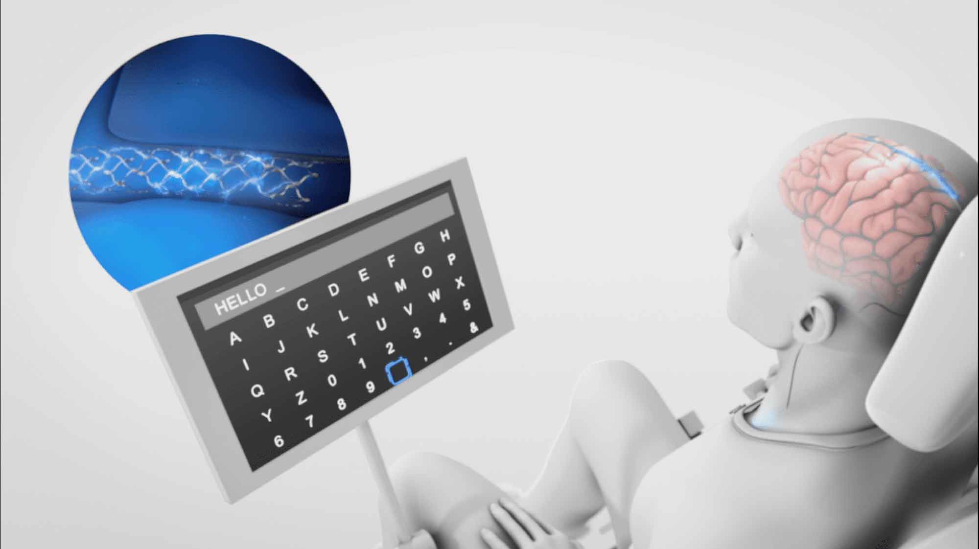 Neural Interface, Synchron's Stentrode™, Paralysis, Direct Brain Control, Assistive Device, Mouse, Keyboard, Vehicles, Freedom, Mobility, Breakthrough Technology, Medical Device, Neurology, Rehabilitation, Physical Therapy, Spinal Cord Injury, Neuroscience, Biomedical Engineering, Medical Innovation, Digital Bypass, Independence, Brain-Computer Interface, Neuroprosthetics.