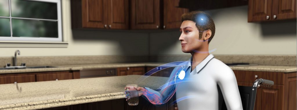 Synchron Stentrode, neural interface, paralysis treatment, digital bypass, brain control, assistive device, independence, freedom, medical specialties: neurology, rehabilitation medicine, physical therapy, occupational therapy, neurosurgery, neurology, neurophysiology, neuroscience, biomedical engineering.