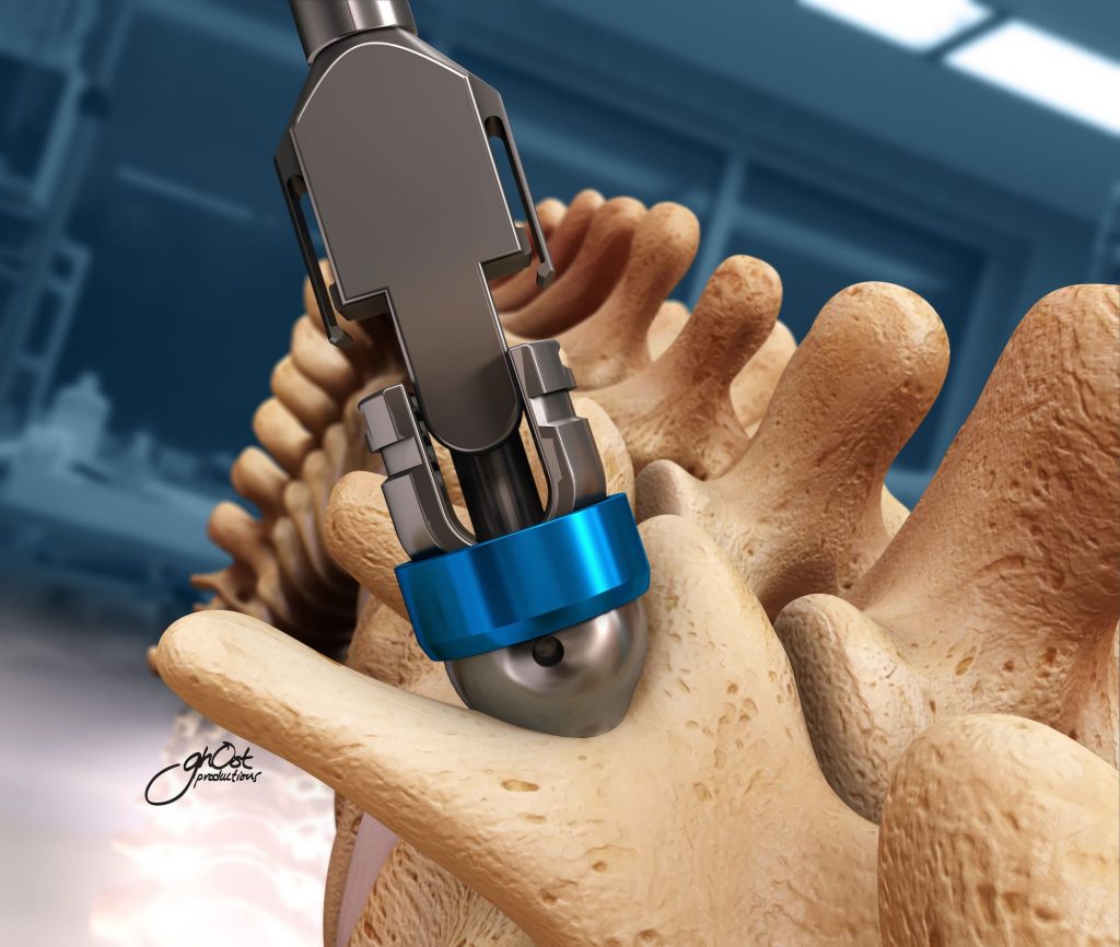 Animation demonstrating the CapSure PS3 Open Pedicle Screw System from SpineWave. Enhances visualization and precision during spinal surgeries. Features include open architecture, intuitive instrumentation, and versatile screw options. Experience the system in action and revolutionize spinal surgery. Created by Capsure Ghost Productions.