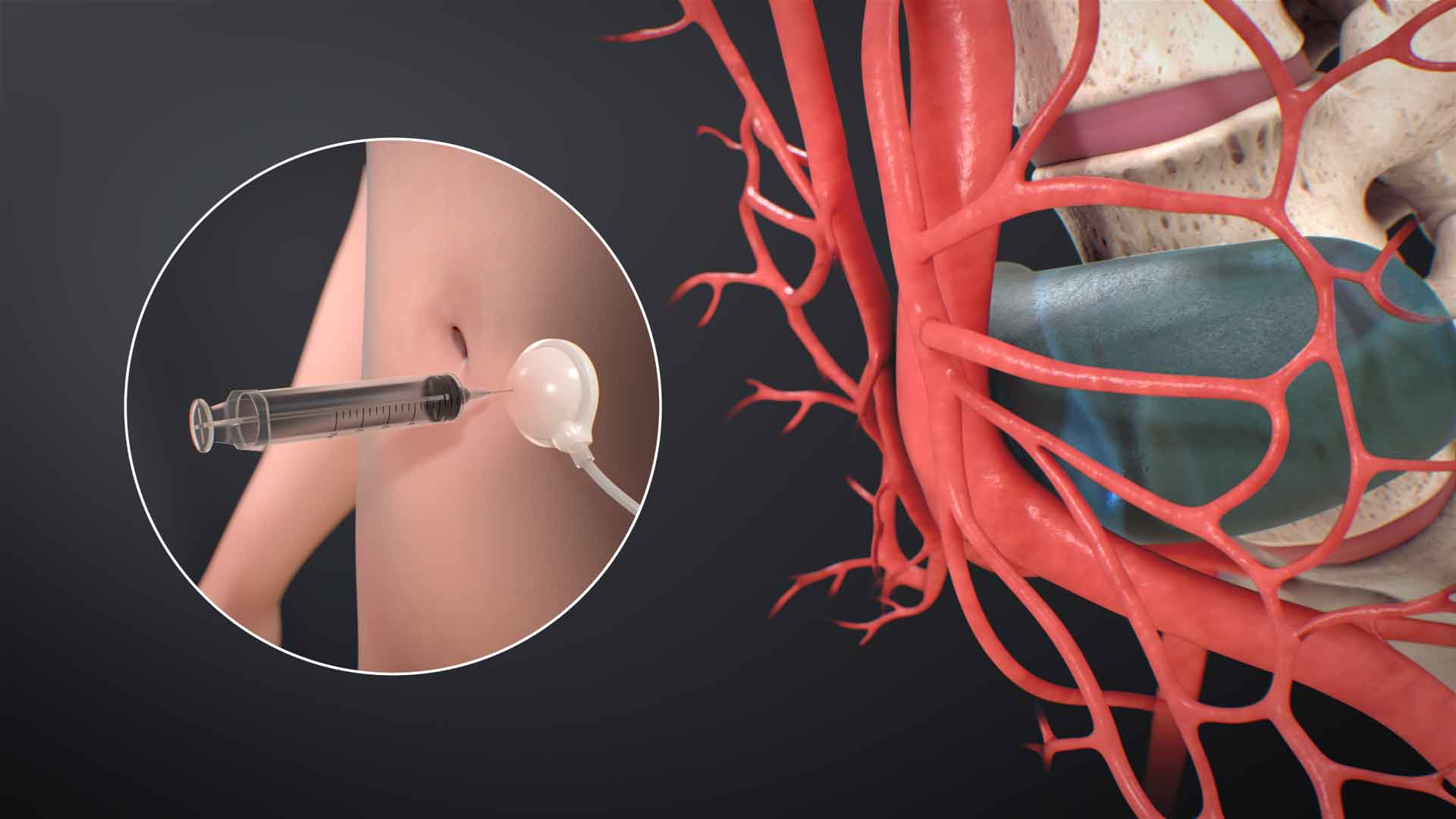 Boston Children's Hospital, Ghost Productions, Midaortic Syndrome, Tissue Expander-Stimulated Artery Lengthening Procedure, medical animation, medical professionals, patients, pathology, cutting-edge treatment, visual explanation, complex medical condition, arterial lengthening, vascular surgery, pediatric surgery, cardiovascular surgery, interventional radiology, vascular medicine, vascular surgery, pediatric cardiology, pediatric vascular surgery, pediatric interventional radiology.