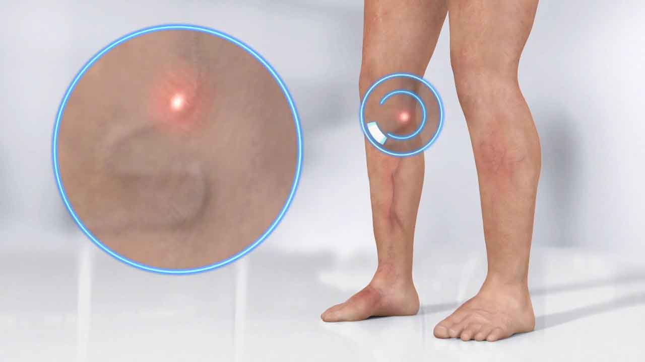 varicose vain laser treatment