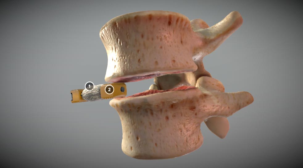 Duo™ Lumbar Interbody Fusion System