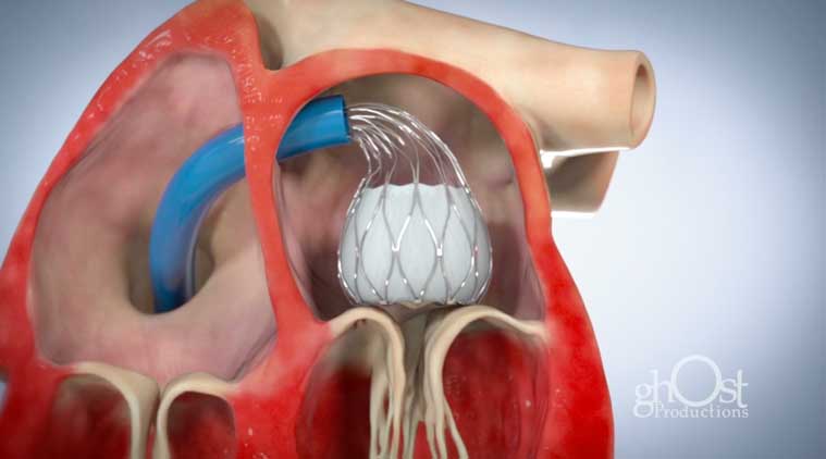 4C Medical | AltaValve™ Supra-Annular (TMVR)