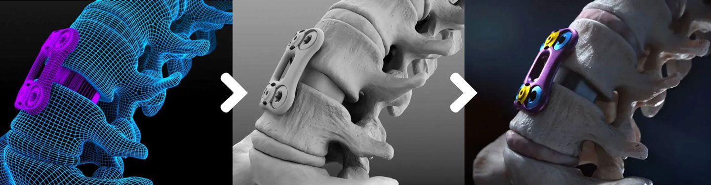 The Process of Creating 3D Medical Illustrations in 2023. showcasing a disk replacement.