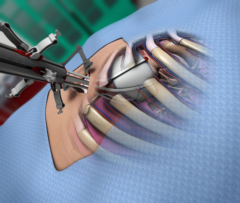 Medical Illustration in 2023: The Shift towards 3D Visualization