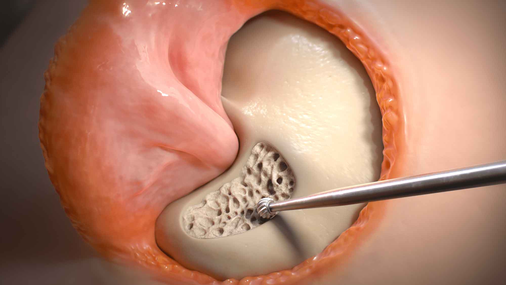 Ear access for brain surgery 