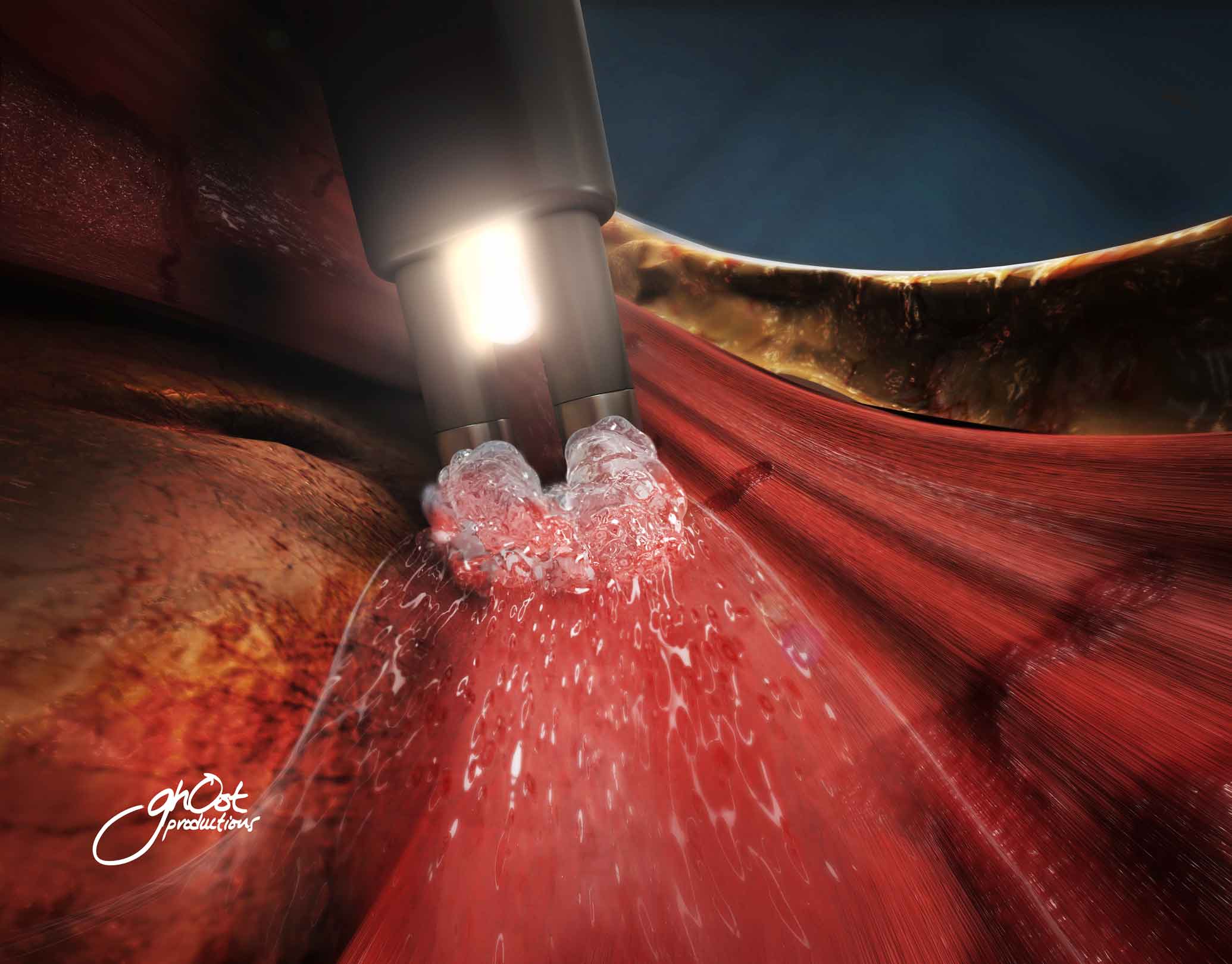 Medtonic Aquamantys device