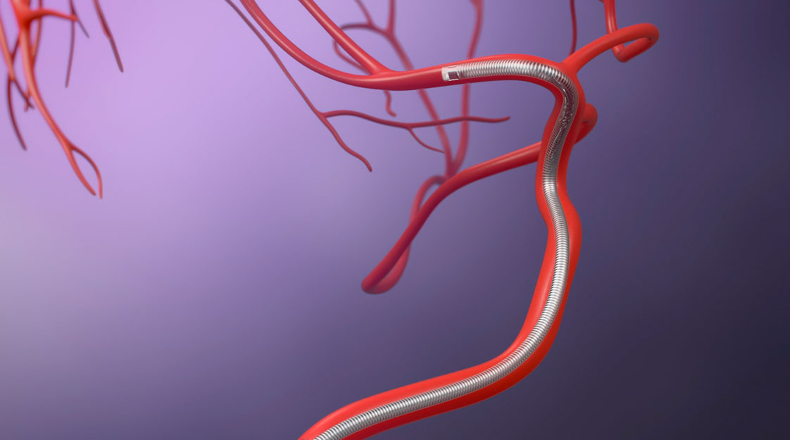 Stryker, AXS Vecta, clot removal, intermediate catheter, extra-large lumen, aspiration, stent retriever, soft tip, distal flex zone, branching arteries, PTFE liner, Trevo NXT ProVue Retriever, visual representation, innovation, stroke treatment, vascular conditions, flexibility, precision, navigability, trauma reduction, collaboration, research and development, accuracy, intuitive, medical professionals, patient care, training, education, procedural planning, technique execution, better outcomes, technology advancement.