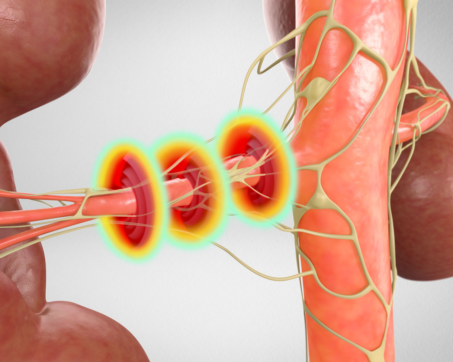Recor Medical's Paradise Renal Denervation System is a revolutionary non-focused ultrasound system designed for this purpose. Through their expertise, Ghost Medical has masterfully translated this cutting-edge technology into a visually stunning medical illustration, encapsulating the essence of the procedure.