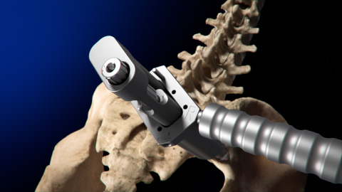 Tenon Medical, Catamaran SI Joint Fusion System, less invasive, Inferior-Posterior approach, SI joint, robust titanium implant, Catamaran Fixation Device, axial plane, sagittal plane, ilium, sacrum, longitudinal axis, pontoon fixated, minimally invasive, visual representation, innovative medical device, precision engineering, surgical expertise, healthcare professionals, patients, medical technology, collaboration, advanced healthcare.