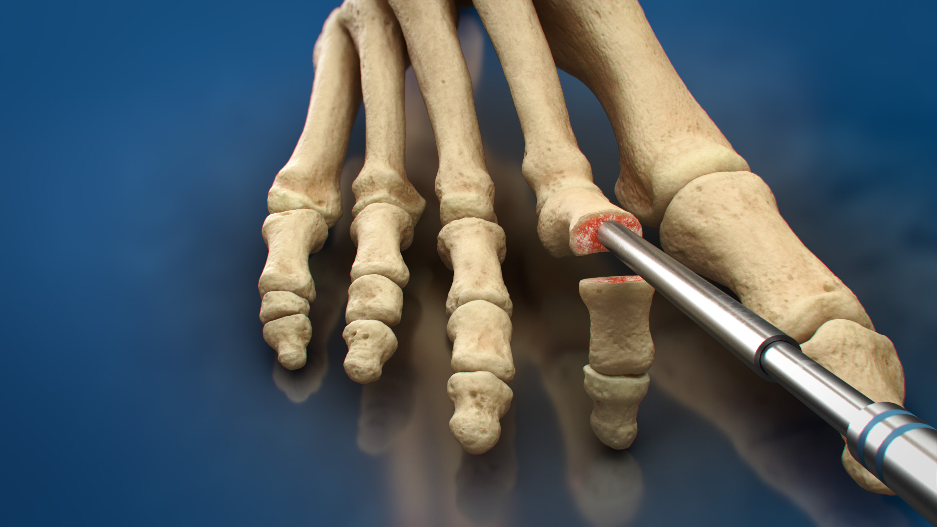 the ZipToe™ Hammertoe System represents a significant step forward in the treatment of rigid hammertoe deformities. With its ASC-focused design, unparalleled precision, and commitment to patient comfort, this revolutionary system is set to transform the way foot and ankle surgeons approach hammertoe correction.