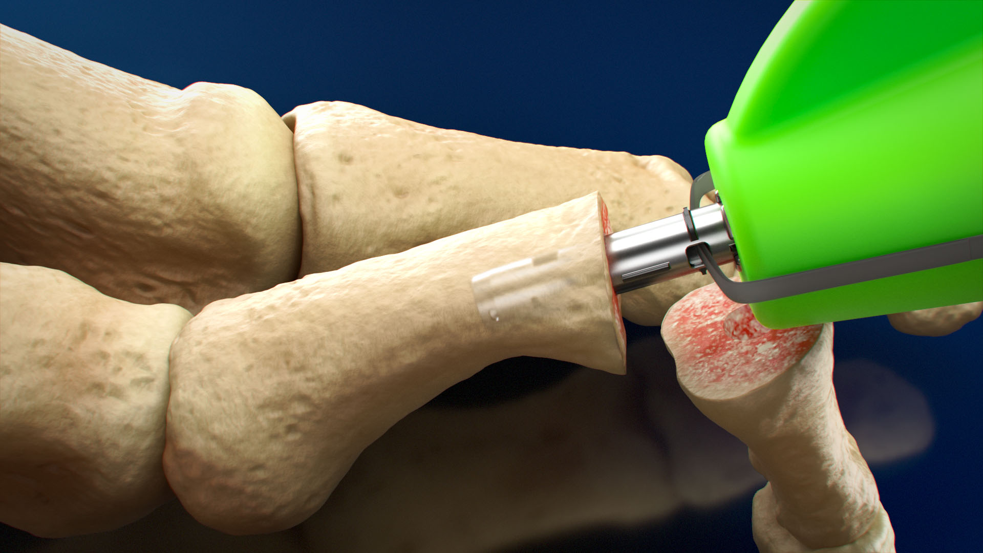 Ghost Medical captured the precision of the Toetal Solutions' ZipToe™ Hammertoe System through advanced 3D Medical Illustration.