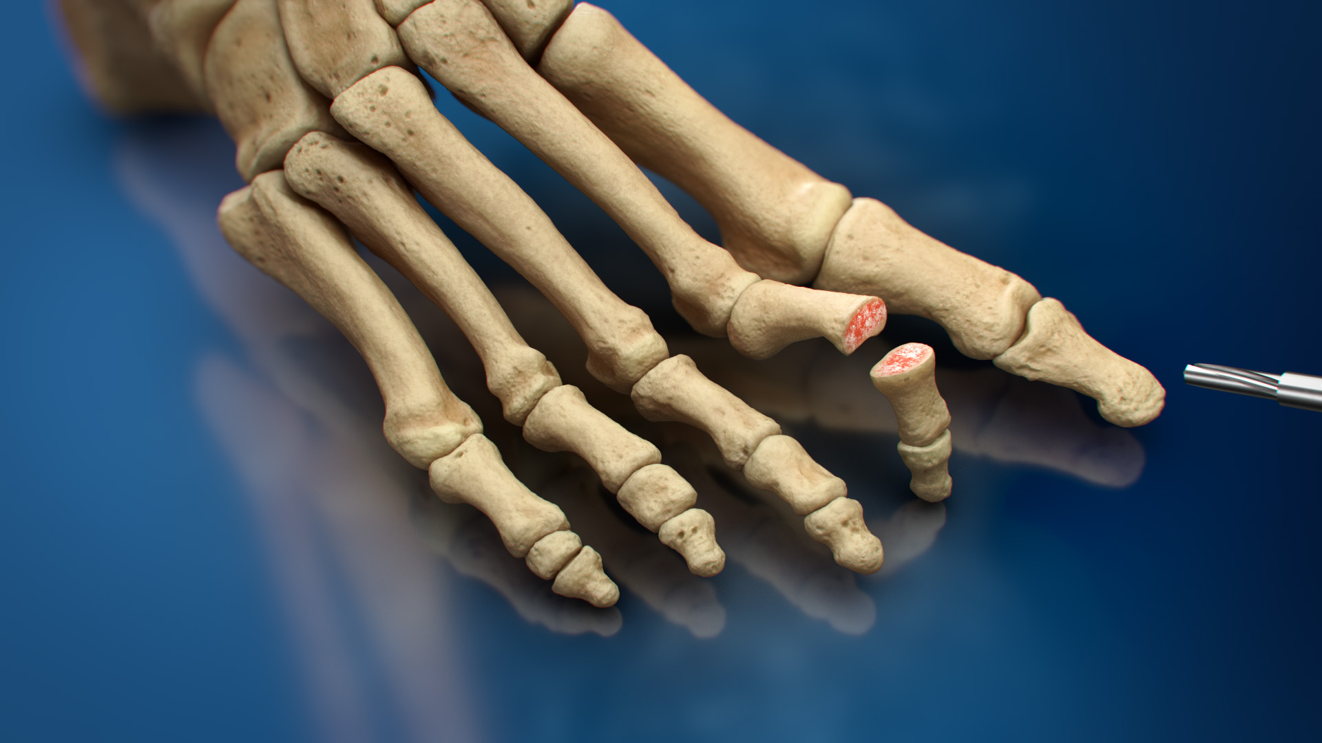 The ZipToe™ Hammertoe System is the result of extensive research, engineering, and collaboration from Toetal Solutions