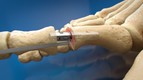 Toetal Solutions, ZipToe™ Hammertoe System, medical illustration, Ghost Medical, rigid hammertoe deformities, foot and ankle surgeons, ASC, cutting-edge design, precision, seamless, ambulatory surgery centers, surgical techniques, patient comfort, outpatient procedures, enhanced, collaboration, visual representation, future, innovation, interdisciplinary cooperation.