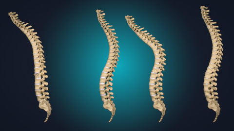 spinal compression fractures, osteoporosis, vertebral tumors, scoliosis, degenerative spondylosis, lumbar degenerative disk disease, medical illustration, Ghost Medical, Neo Medical, spinal deformities, spinal injuries, comparative analysis.