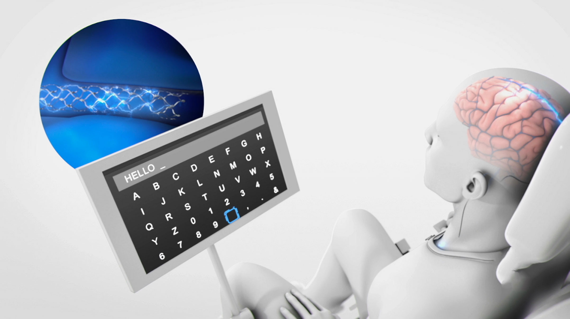 with the stentrode, Patients can now train their minds to achieve direct control over various devices, such as computer mice, keyboards, exoskeletons, and even vehicles.