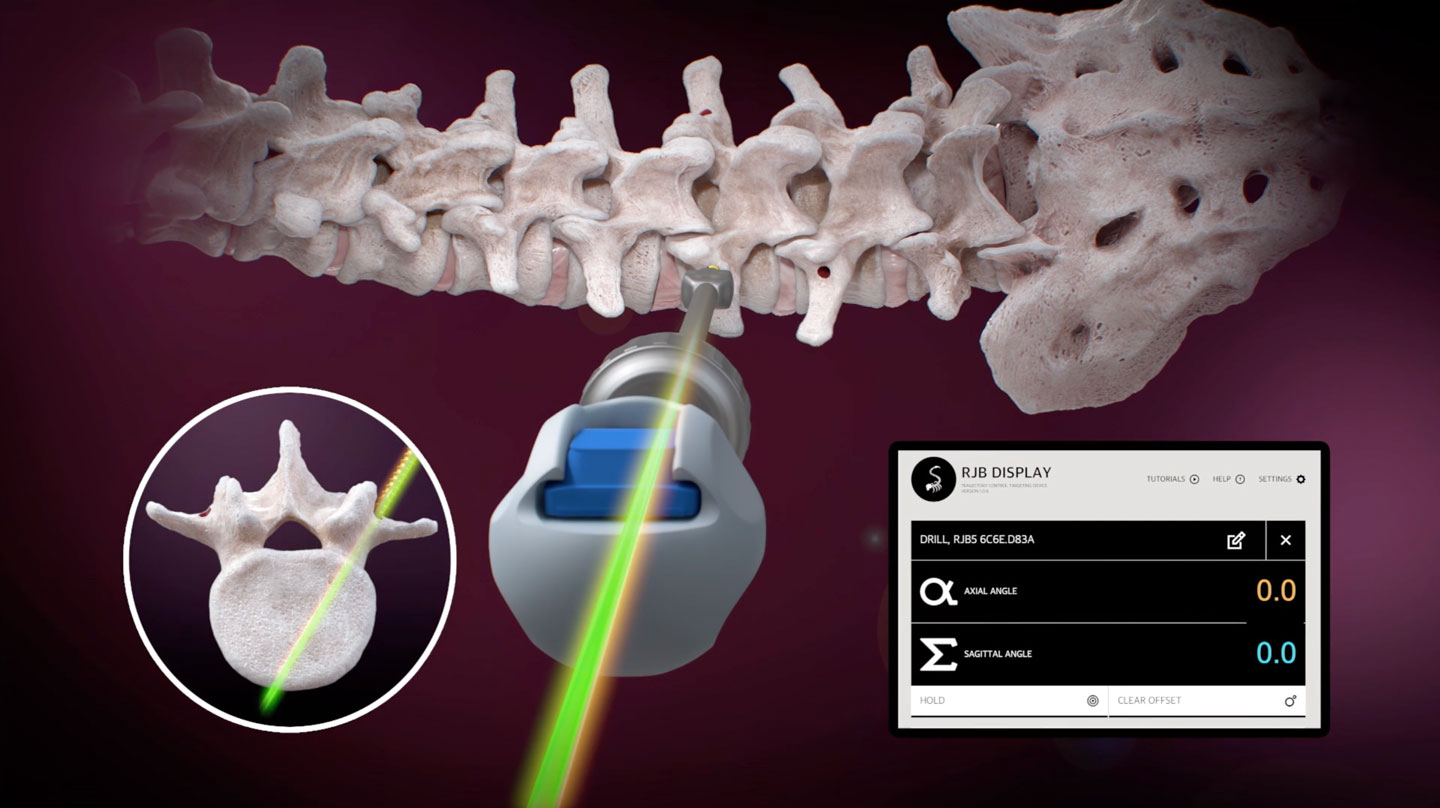  Ruthless Spine has recently obtained FDA approval for their RJB Spinal Navigation Device