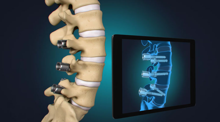 Pioneering Advancements in Spine Surgery with Neo Medical