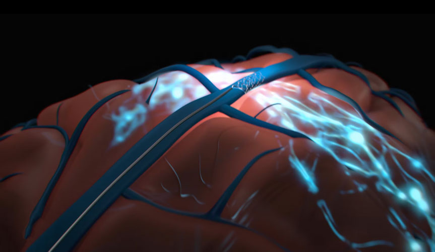 "The Stentrode" Brain Implant - Synchron Animation