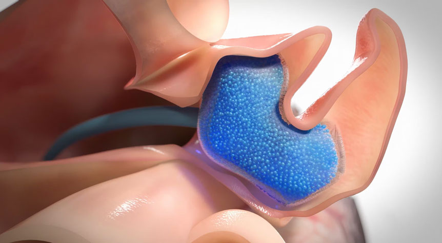Ghost Medical's High-fidelity 3D animation showcasing MIT’s innovative shear-thinning micro-gel implant for LAA occlusion. It is designed to conform, seal, and biointegrate with atrial tissue.