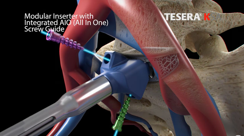 Kyocera Medical's Tesera® SA ALIF Cage System - Animation