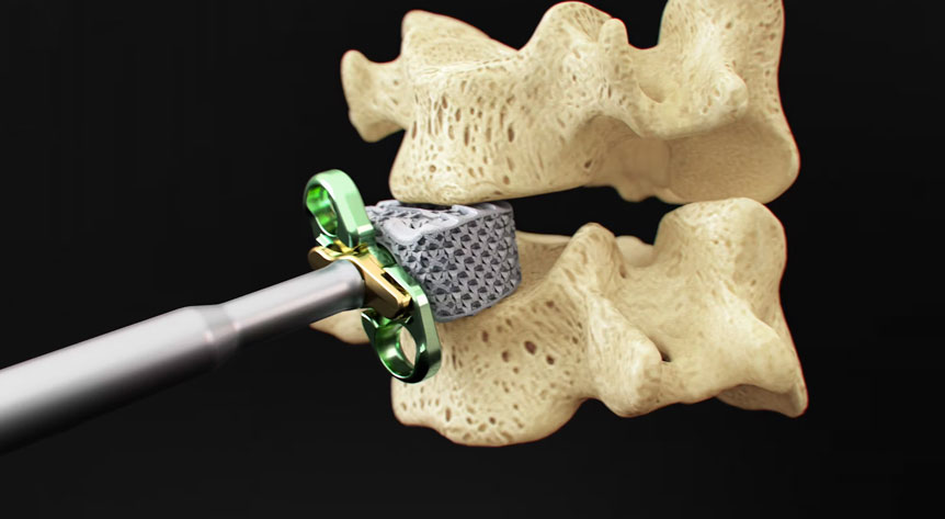 NanoHive's HIVE Standalone Cervical System - Medical Device Animation 