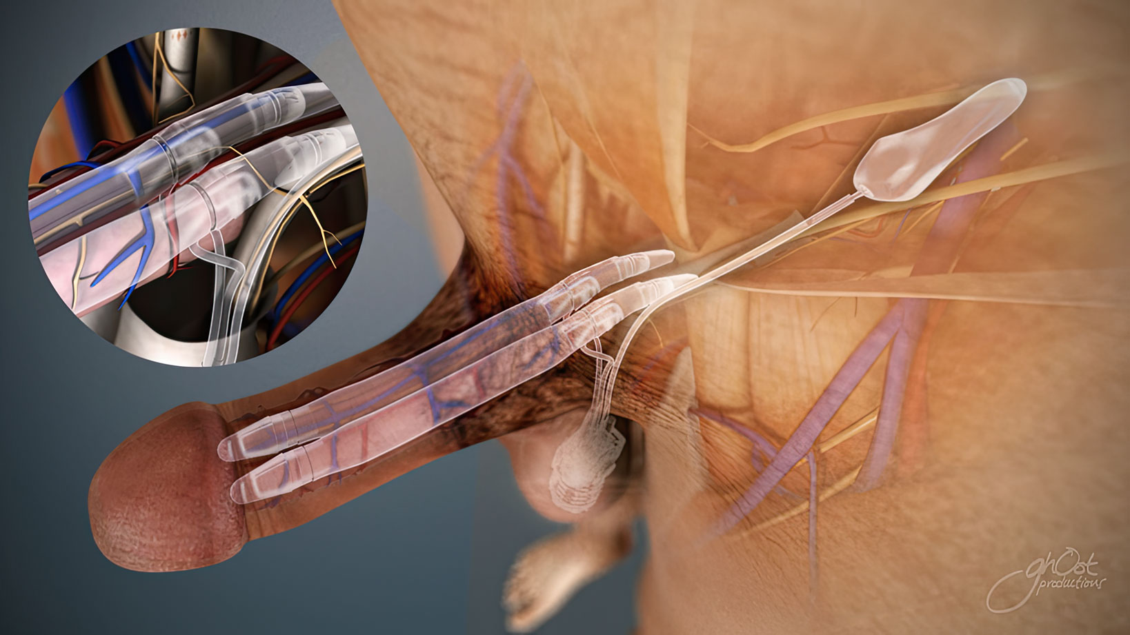 The AMS 700™ Penile Implant Visualized inside of a patient