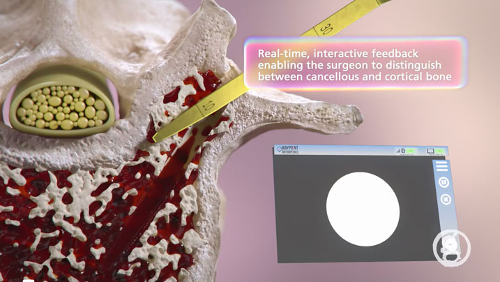 Ghost Productions creates stunning animation for Waypoint Orthopedics' Guided Pedicle System, reducing need for radiation in spinal procedures. Contact for services.